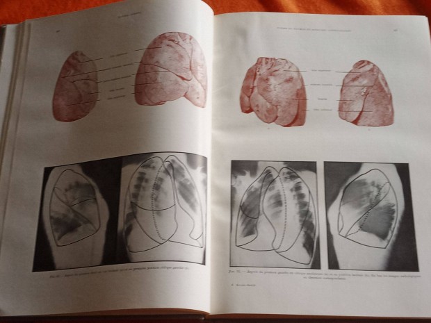 Les Fondements Anatomo-radiologiques de L'Investigation Pulmonaire (A