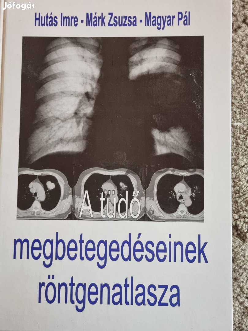 A tüdő megbetegedéseinek röntgenatlasza