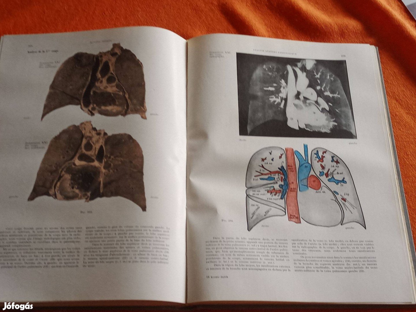 Les Fondements Anatomo-radiologiques de L'Investigation Pulmonaire (A