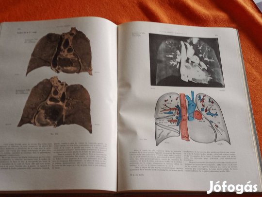 Les Fondements Anatomo-radiologiques de L'Investigation Pulmonaire (A